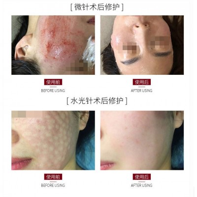 e.gf微针寡肽修护冰膜微创退红蚕丝面膜中胚浅导敏感晒后修护院用图2