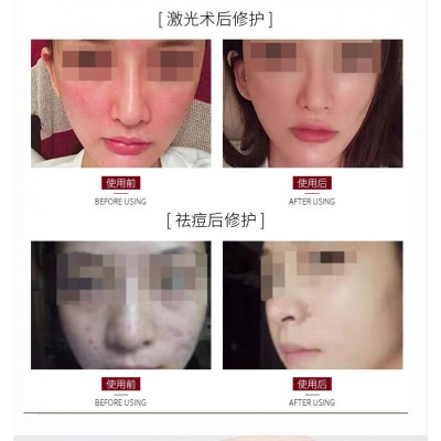 e.gf微针寡肽修护冰膜微创退红蚕丝面膜中胚浅导敏感晒后修护院用图4