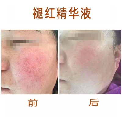 控色液斑敏痘褪红精华液 斑后保湿保养液 角质层修复护理 美容院图3