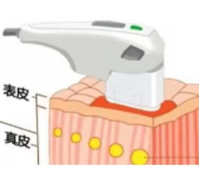 解答超声刀美容效果怎么样、超声刀的功效和作用~