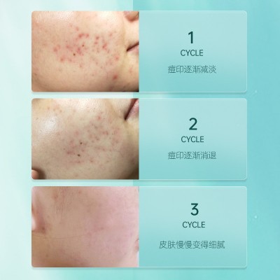 暨大修护冻干粉5对装术后敏感激素过敏红血丝寡肽冻干粉套盒批发图5
