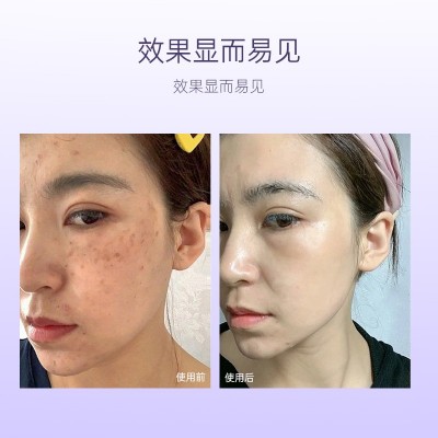 一秒擦斑液提取液雀斑老年斑祛斑金水零结痂美白无创祛斑液化妆品图4