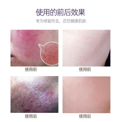 院装退红修复冰晶修复红血丝干燥脱皮晒伤泛红补水保湿冰晶啫喱图2