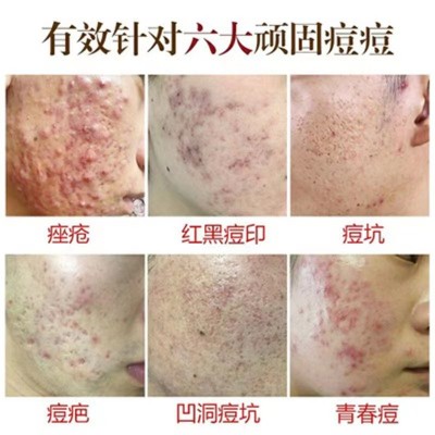 草本绝痘术微晶去痘印粉刺青春痘修护祛痘水美容院祛痘精华液批发图5