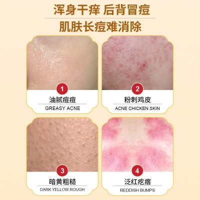 国药精养韩芭拉硫磺除螨液体香皂沐浴露药皂净螨抑菌洗护 除螨皂图3