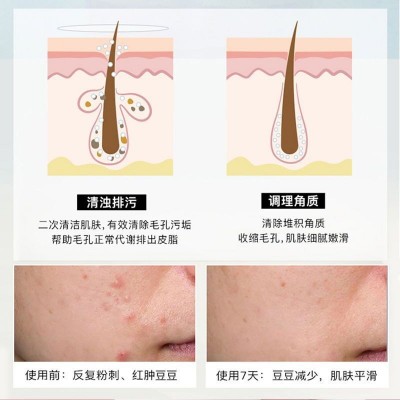 YIRANTIAN水杨酸棉片温和祛痘控油收缩毛孔面部清洁痘肌修护精华图4