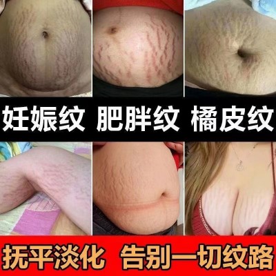妊娠纹修复霜产后去孕纹淡化肥胖纹润肤预防生长纹祛妊娠纹疤痕膏图2