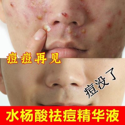 水杨酸爽肤水果酸精华液去闭口粉刺湿敷水祛痘印修复毛孔粗大批发图2