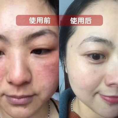 神经酰胺原液舒缓退红去红血丝修护角质层敏感肌激素脸修复精华液图2