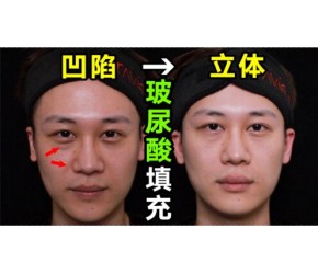 玻尿酸填充泪沟、法令纹，改善脸型效果惊艳！
