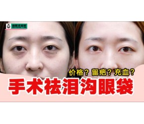 泪沟治好了！花费万元终于找到了医美解决方法！