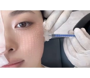 水光针医疗美容
