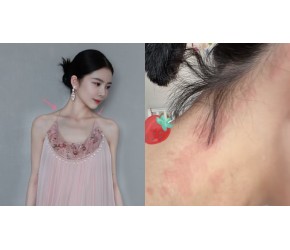 杜淳妻子自曝注射肉毒致全身严重过敏：奇痒无比，背部满是红疙瘩