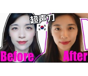 韩国微整形体验：抗初老，超声刀有效没？