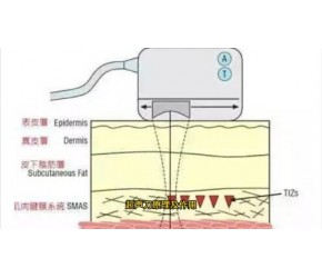 超声刀原理及作用~