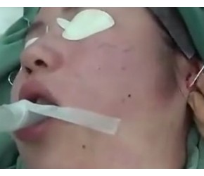 实拍 脸部抽脂整形美容手术